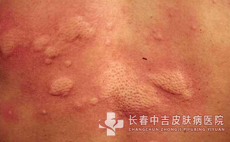 荨麻疹有哪些治疗方法?