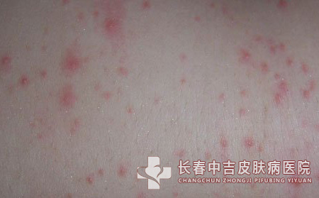荨麻疹的家庭治疗方法