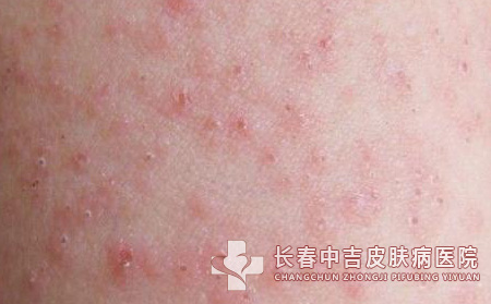 如何医治荨麻疹