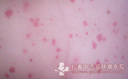 怎么样治疗荨麻疹?