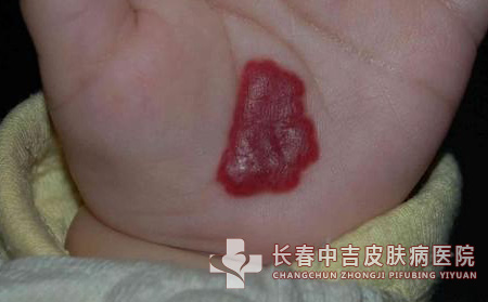 血管瘤治疗,血管瘤患者,长春中吉皮肤病医院