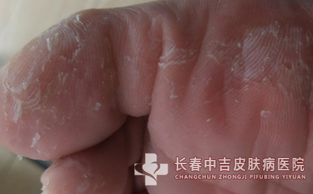 影响手足癣治疗的因素有哪些