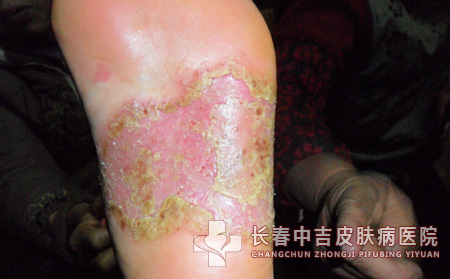 足癣患者生活中注意什么