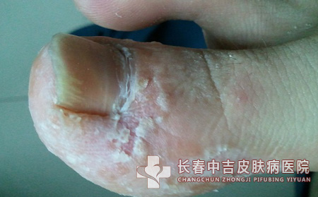 足癣护理,足癣患者,长春中吉皮肤病医院