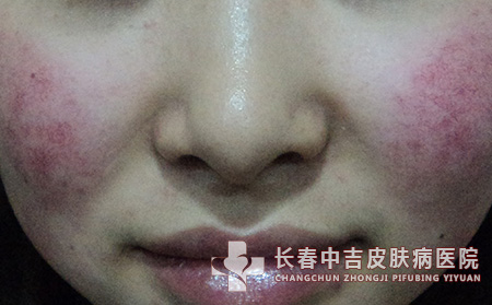 儿童脸上的红血丝是怎么出现的
