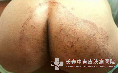 股癣症状