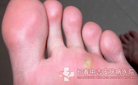 跖疣,跖疣治疗,长春中吉皮肤皮肤病医院