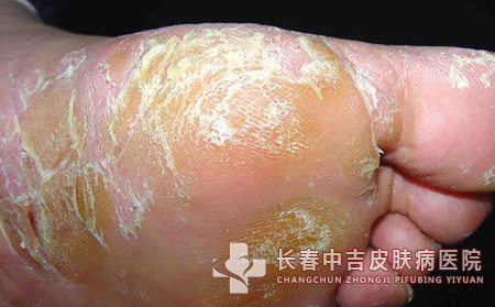 足癣饮食,足癣患者,长春中吉皮肤病医院