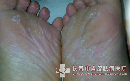 足癣的发病与哪些食物有关系