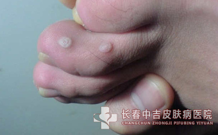 跖疣,跖疣治疗,长春中吉皮肤皮肤病医院
