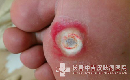 跖疣,跖疣治疗,长春中吉皮肤皮肤病医院