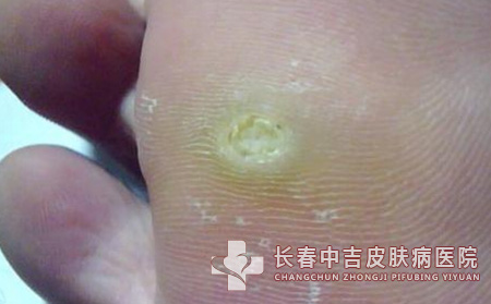 跖疣,跖疣治疗,长春中吉皮肤皮肤病医院