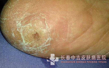 跖疣,跖疣预防,长春中吉皮肤皮肤病医院