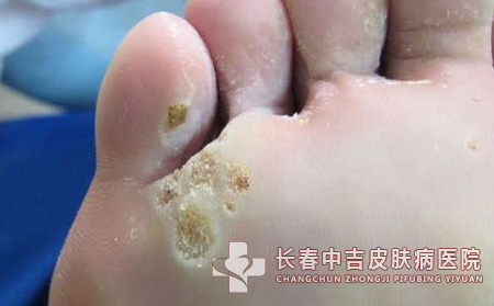 跖疣,跖疣预防,长春中吉皮肤皮肤病医院