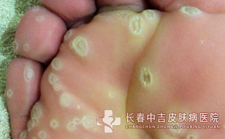 跖疣,跖疣预防,长春中吉皮肤皮肤病医院