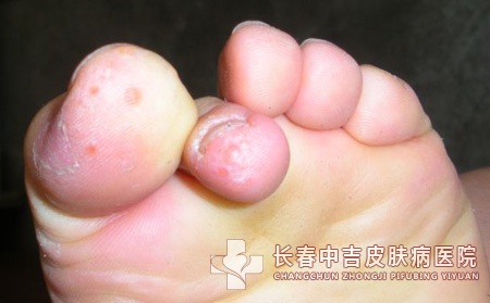 手足癣怎样防治