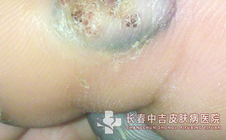 跖疣,跖疣预防,长春中吉皮肤皮肤病医院