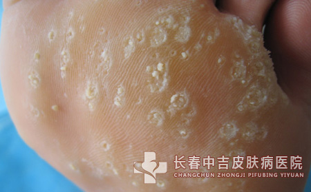 跖疣,跖疣治疗,长春中吉皮肤皮肤病医院