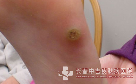 跖疣,跖疣治疗,长春中吉皮肤皮肤病医院