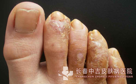 足癣饮食,足癣患者,长春中吉皮肤病医院