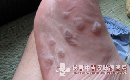 跖疣,跖疣治疗,长春中吉皮肤皮肤病医院