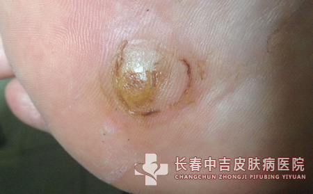 跖疣,跖疣治疗,长春中吉皮肤皮肤病医院