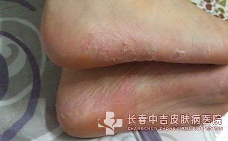 足癣饮食,足癣患者,长春中吉皮肤病医院