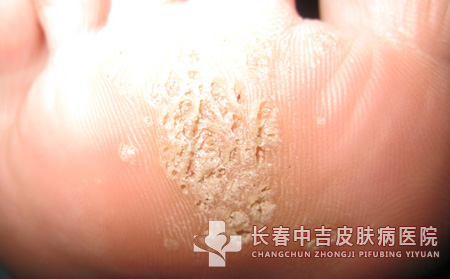 跖疣,跖疣治疗,长春中吉皮肤皮肤病医院
