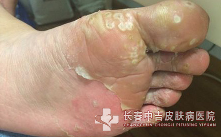 跖疣,跖疣治疗,长春中吉皮肤皮肤病医院