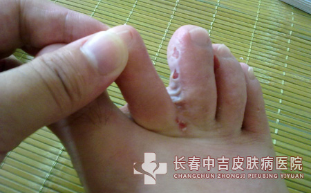 足癣饮食,足癣患者,长春中吉皮肤病医院