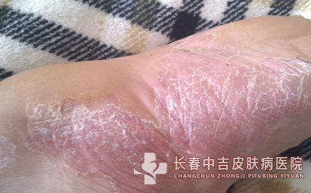 怎样饮食对足癣的治疗有帮助