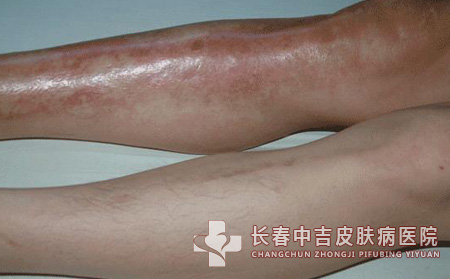 儿童皮肤硬化性纤维瘤病