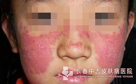 新生儿红斑狼疮案例的分析