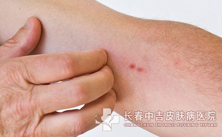 糖尿病合并皮肤病发病情况调查
