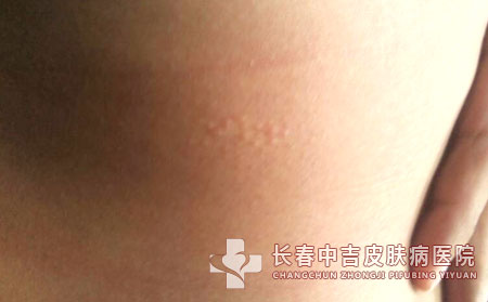 紫外线辐射对人类皮肤健康的影响