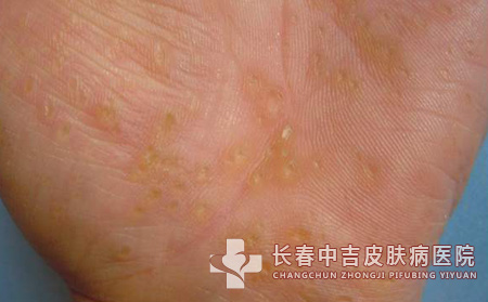 扁平苔藓样角化病案例分析