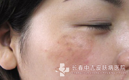 女性预防黄褐斑吃什么水果效果合适