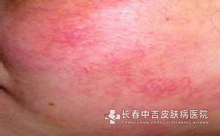 面部红血丝出现的原因是什么?