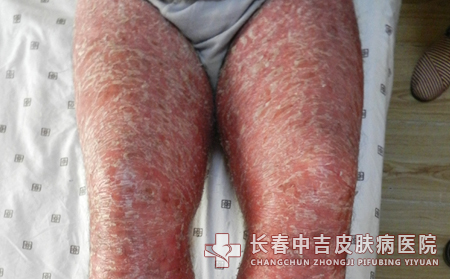 牛皮癣患者在预防时出过哪些问题