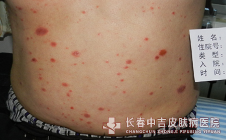 牛皮癣患者预防复发之良合适的生活习惯