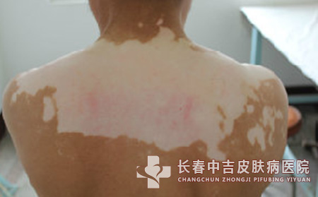 白癜风病因