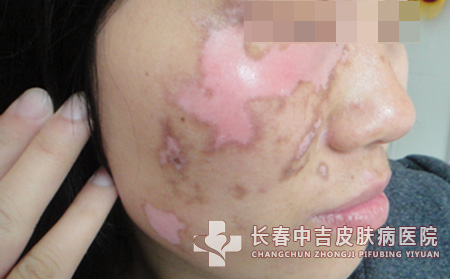 让患者更清楚的白癜风基本症状