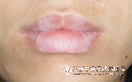 夏季白癜风患者的精神护理方法