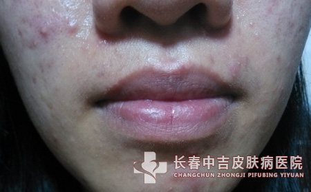 一些治疗皮炎的方法存在的弊端详解