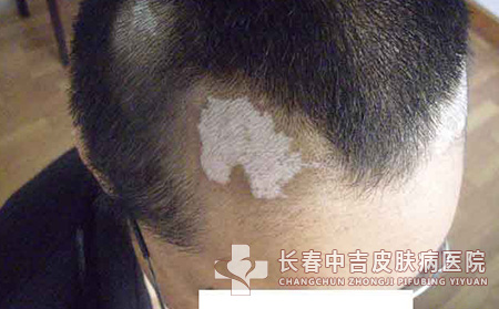 老年白癜风患者该如何进行临床治疗