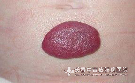 探秘婴儿出现血管瘤的原因有哪些?