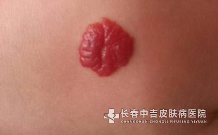 哪些原因导致血管瘤的发生?