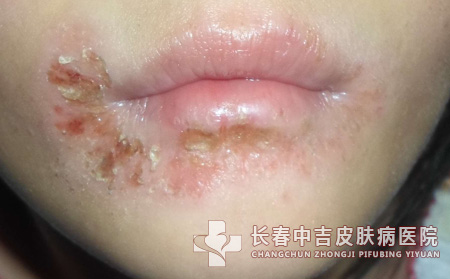 患上化妆品皮炎之后女性应该如何治疗疾病