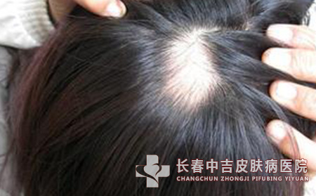 女性为什么会出现斑秃的病理原因解析