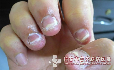 灰指甲遗传